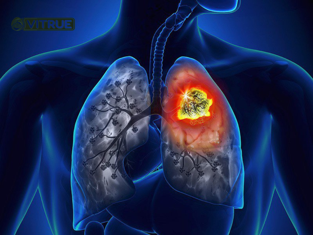 Ung thư phổi và những điều mà bạn không thể bỏ qua 1