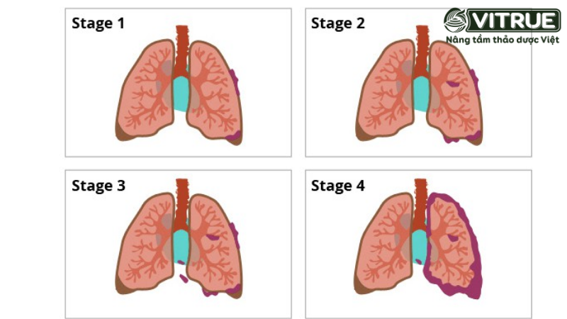 Giải đáp băn khoăn: Ung thư phổi sống được bao lâu 1