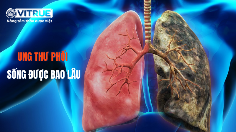 Giải đáp băn khoăn: Ung thư phổi sống được bao lâu?