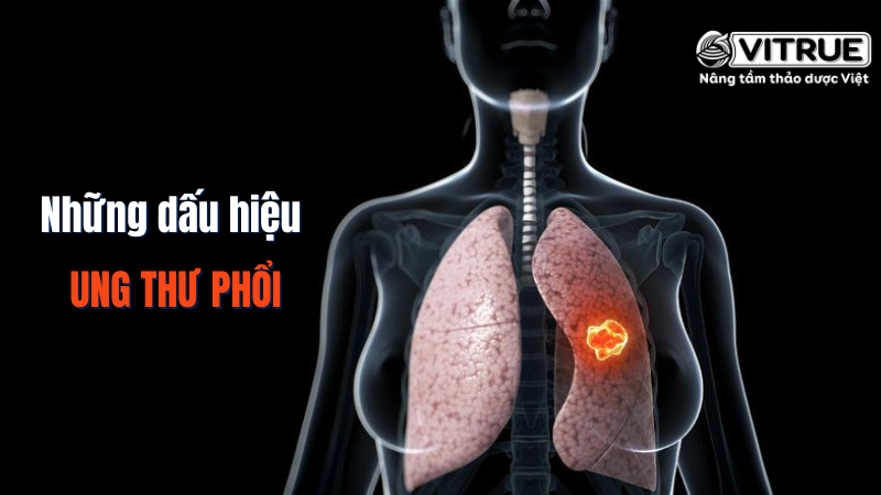 Những dấu hiệu ung thư phổi dễ nhận biết nhất 1