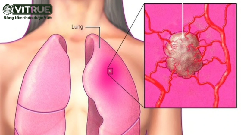 Các triệu chứng khi bị ung thư phổi giai đoạn cuối 4