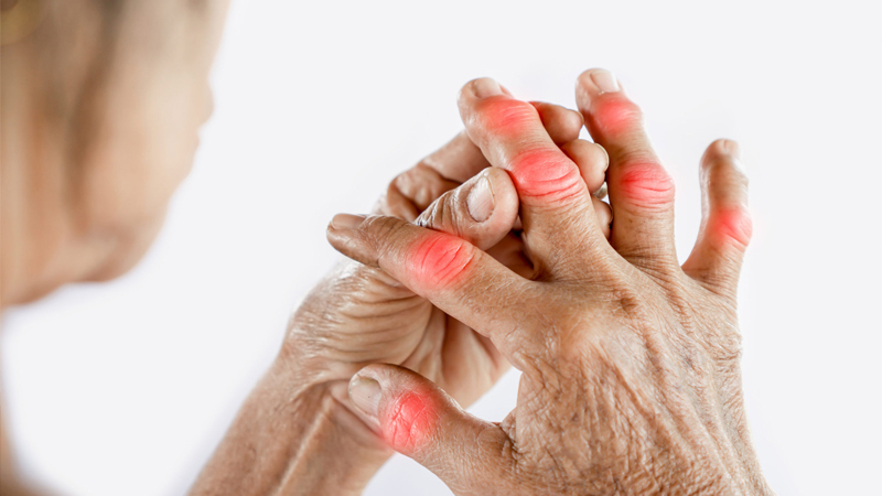 4  dấu hiệu bệnh gout phổ biến, ai cũng có thể nhận biết