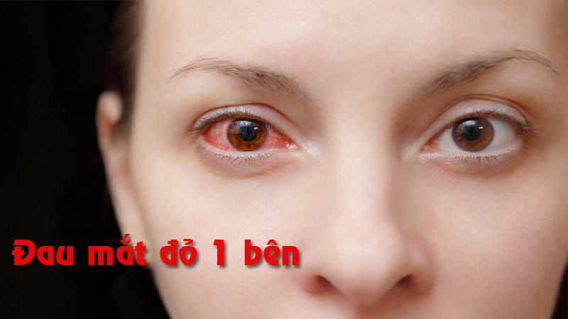 Bị đau mắt đỏ 1 bên làm gì để không lây sang mắt còn lại?