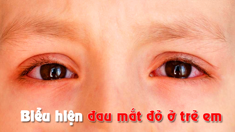 Bệnh đau mắt đỏ ở trẻ em có biểu hiện gì? Khi nào cần đi khám?