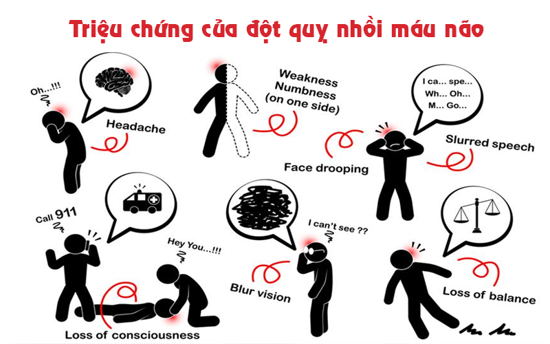 đột quỵ nhồi máu não 2