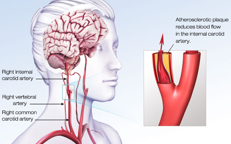 đột quỵ nhồi máu não 3