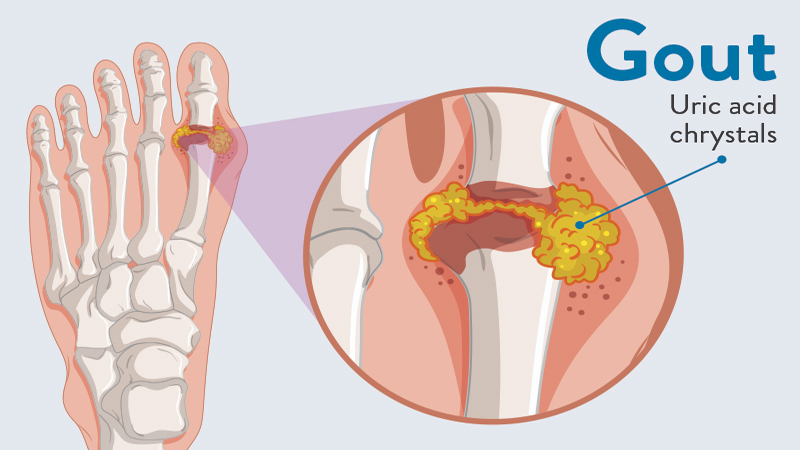 6 Lý do bị gout ai cũng từng mắc phải mà không biết