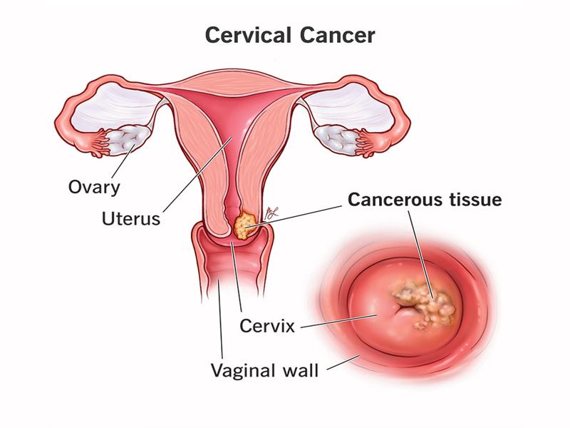 cách nhận biết ung thư cổ tử cung 1