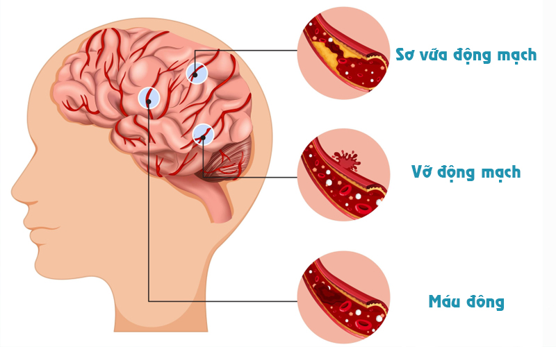 tai biến và đột quỵ 3